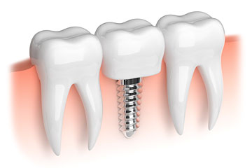 dental implant